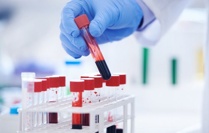 First woman reported cured of HIV after stem cell transplant